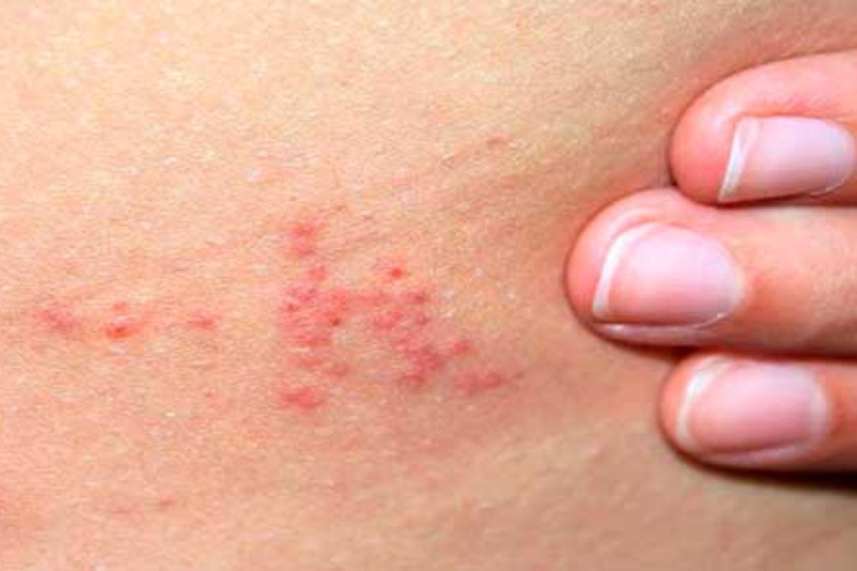 Як розрізнити укуси та що робити після? 7