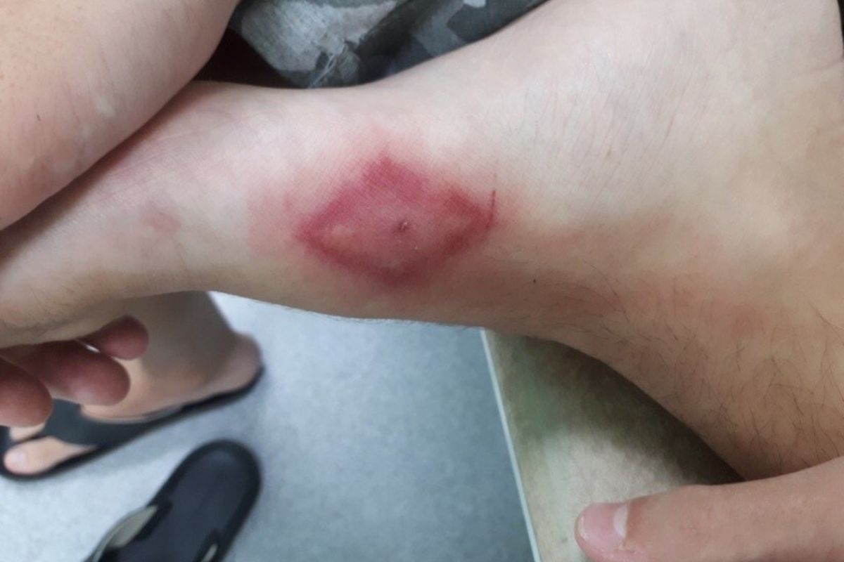 Як розрізнити укуси та що робити після? 8