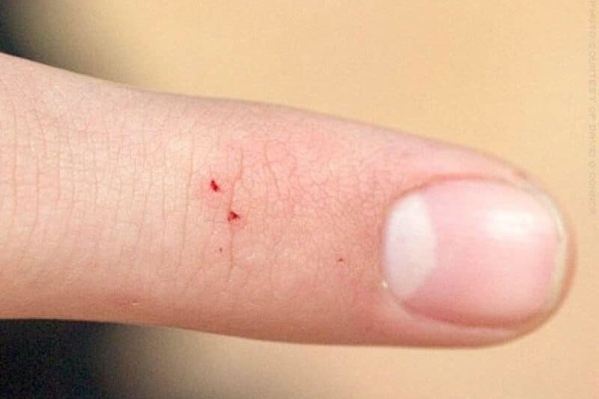 Як розрізнити укуси та що робити після? 9