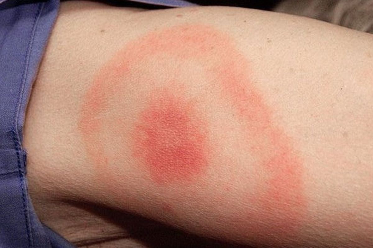 Як розрізнити укуси та що робити після? 10