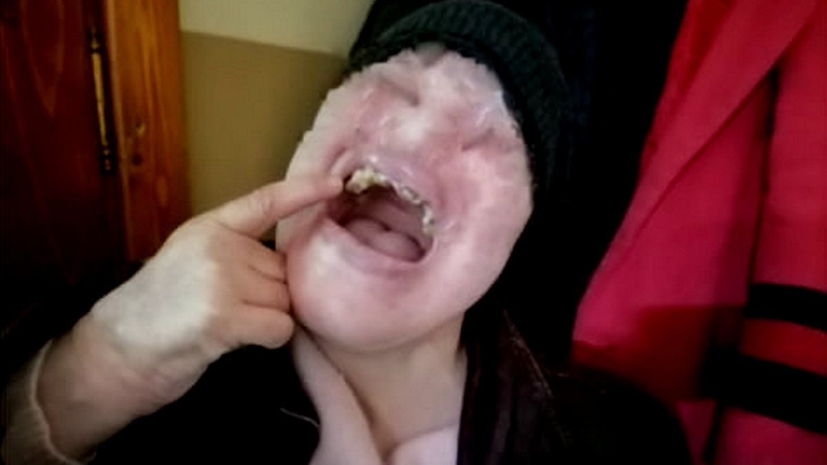 Без води, повітря та з тілесними ушкодженнями: умови перебування у Делятинському психоневрологічному інтернаті 2