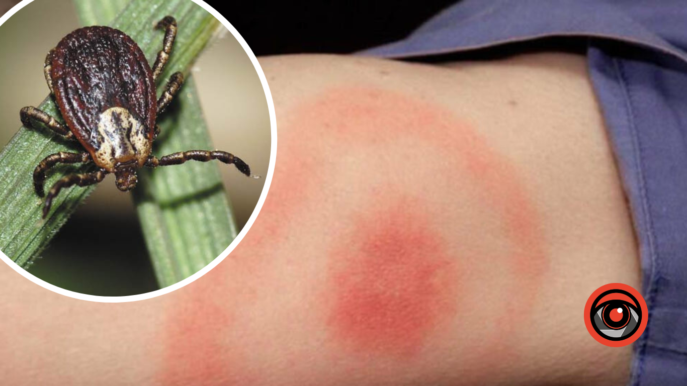 На Косівщині зареєстрували випадок хвороби Лайма