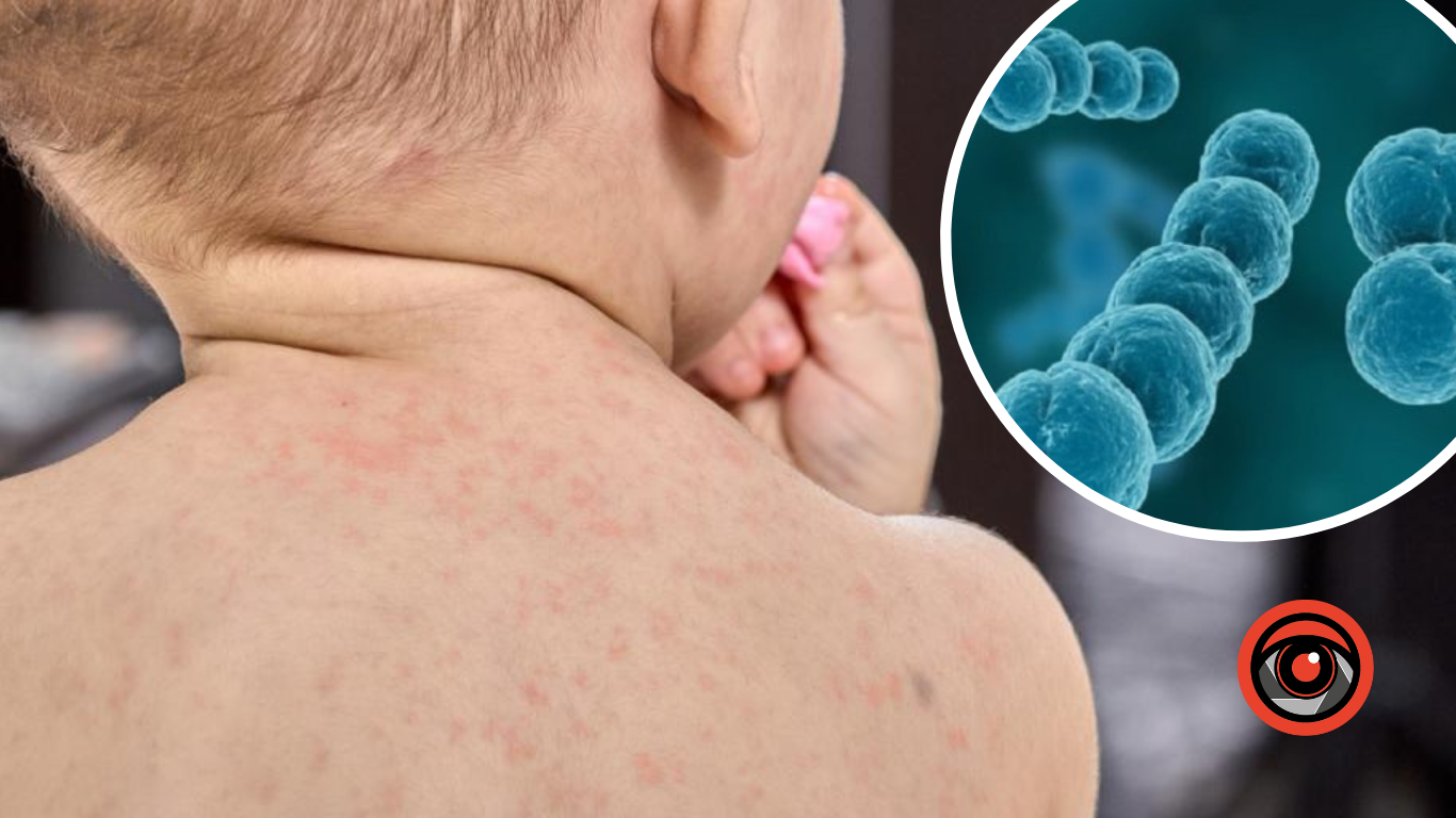 На Прикарпатті фіксують випадки скарлатини