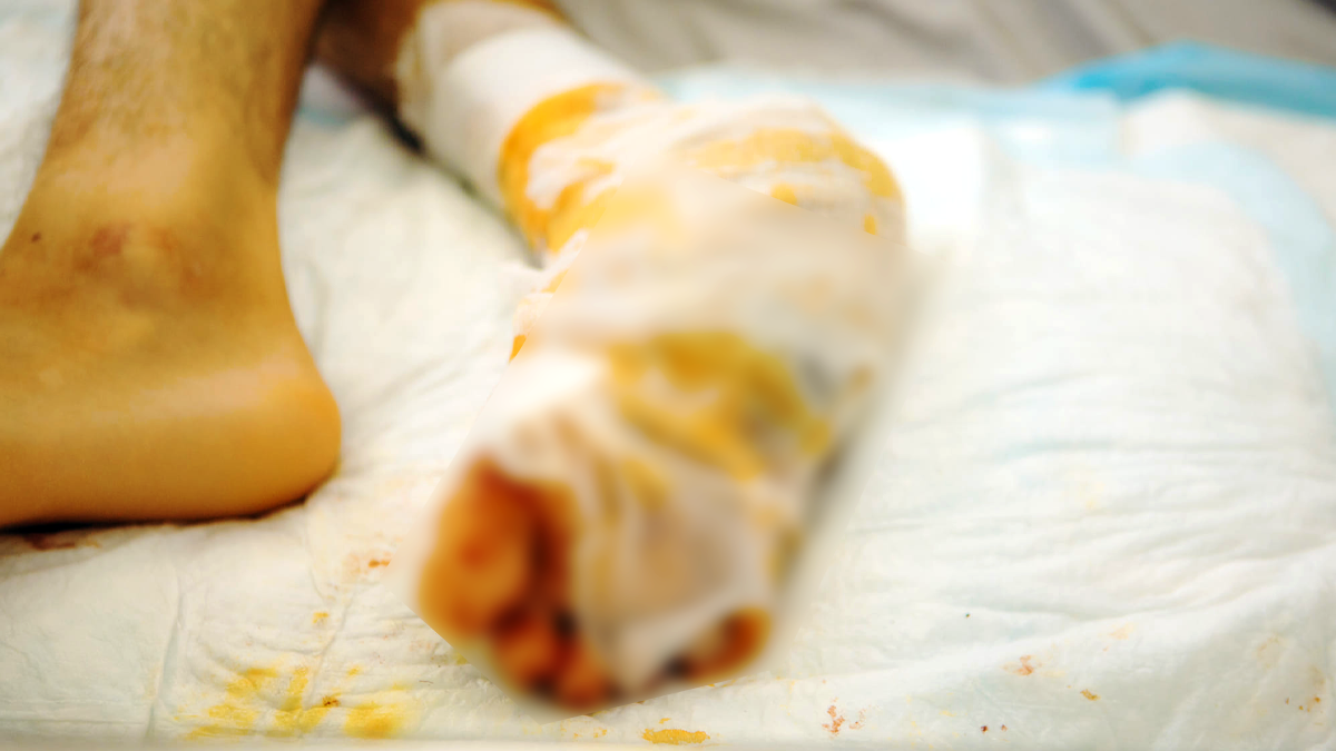 Завдяки сучасній методиці лікарі змогли зберегти п'яту підлітку з Косівщини, який впав з велосипеда 1