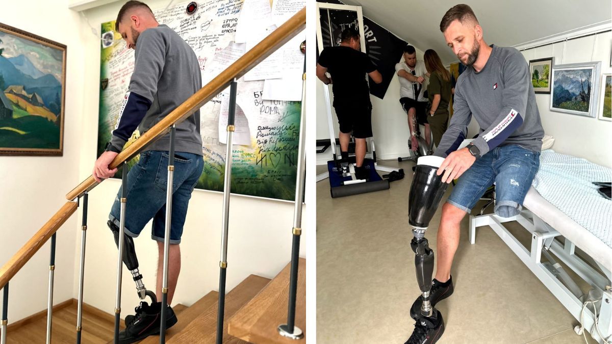 Воїну з Печеніжина встановили унікальний протез із мікропроцесором 1