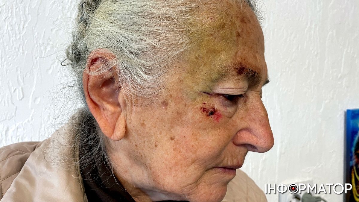 Коломиянка зламала руку посеред тротуару 1