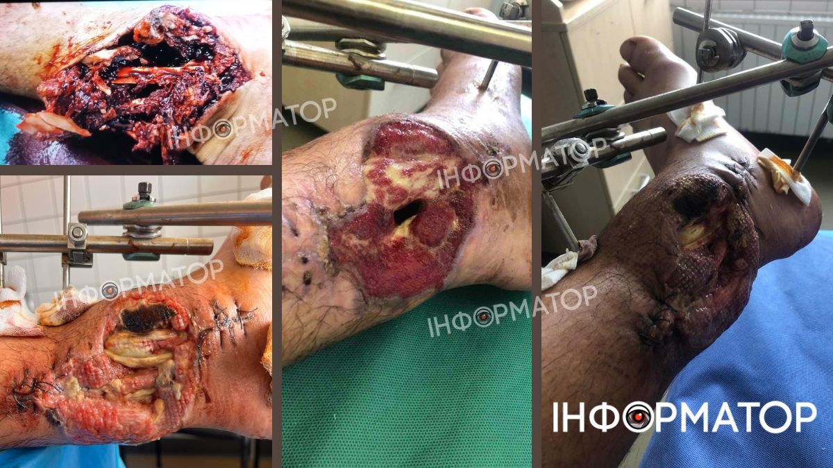 Верховинське сафарі: підозрювані заявляють, буцімто сплутали хлопця з кабаном 1