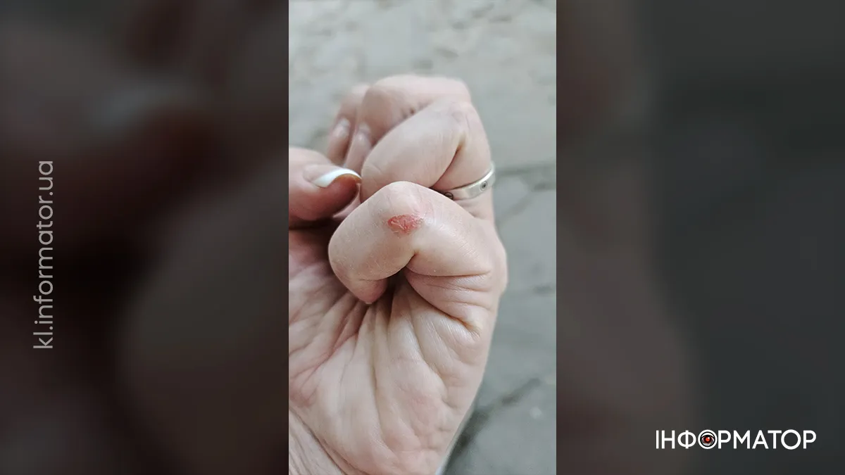 Для коломийнки напад завершився кількома синяками і подряпинами Для коломийнки напад завершився кількома синяками і подряпинами