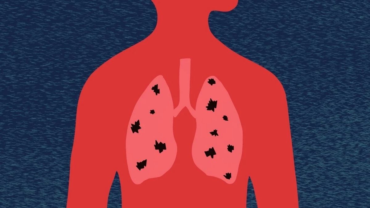 37 випадків туберкульози виявили на Прикарпатті в грудні