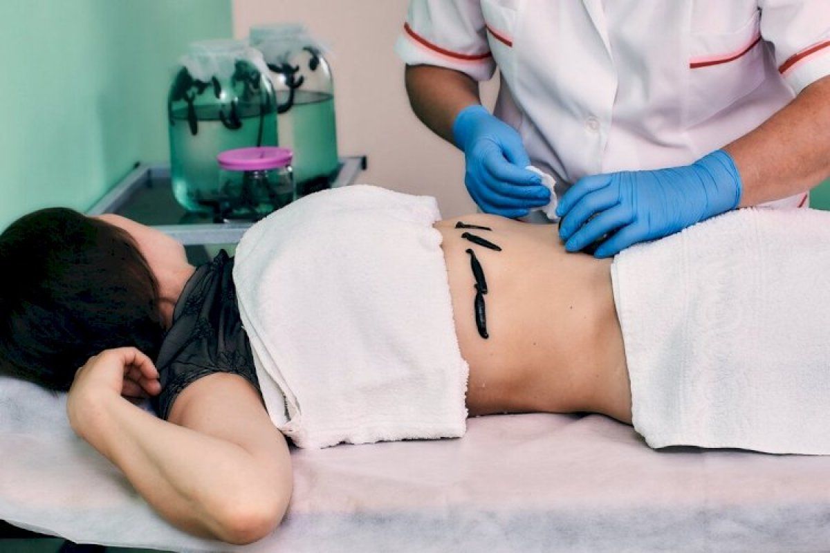 Процедуру должен проводить только специалист, и после консультации с гирудотерапевтом или хотя бы семейным врачом. Процедуру должен проводить только специалист, и после консультации с гирудотерапевтом или хотя бы семейным врачом.