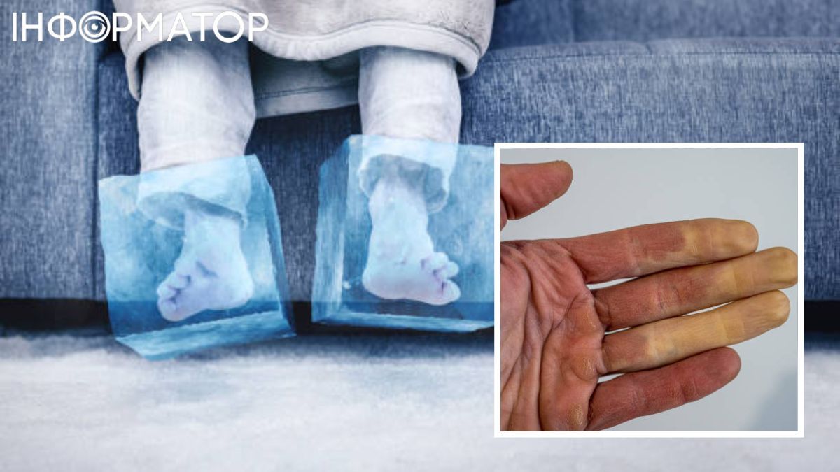 Обмороженння призводить до жахливих наслідків. Обмороженння призводить до жахливих наслідків.