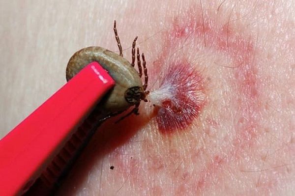 Для постконтактної профілактики від вилучення кліща має пройти не більше 36 годин. Для постконтактної профілактики від вилучення кліща має пройти не більше 36 годин.