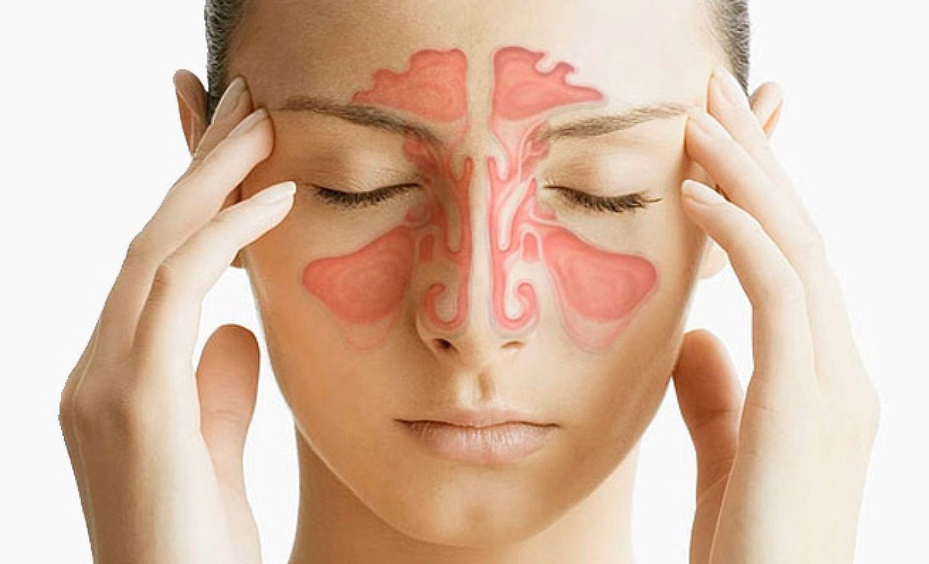 Аллергический ринит способен сделать жизнь невыносимой. Аллергический ринит способен сделать жизнь невыносимой.