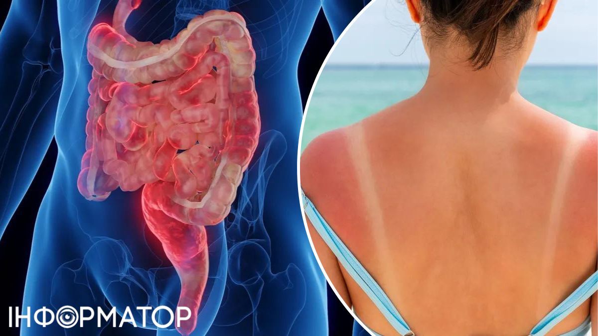 Неандертальські варіанти генів пов'язані із захистом від ультрафіолету. Неандертальські варіанти генів пов'язані із захистом від ультрафіолету.