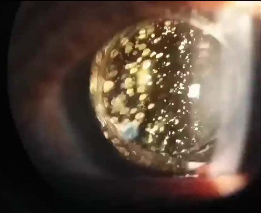 Через офтальмоскоп виходить видовищний вид.