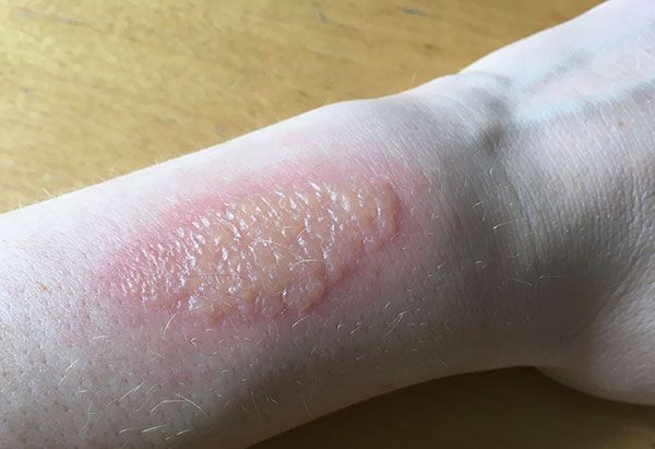 Від борщівника виходить справжнісінький опік. Від борщівника виходить справжнісінький опік.