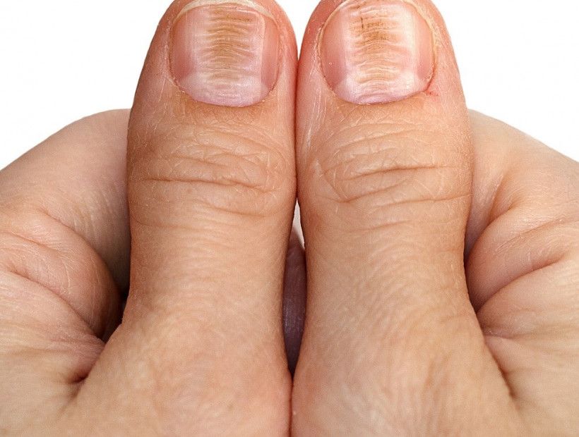 Лінії Бо - знак того, що якась недуга заважає нігтям рости. Лінії Бо - знак того, що якась недуга заважає нігтям рости.