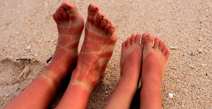 Главное в лечении ожога - охлаждение и увлажнение. Главное в лечении ожога - охлаждение и увлажнение.