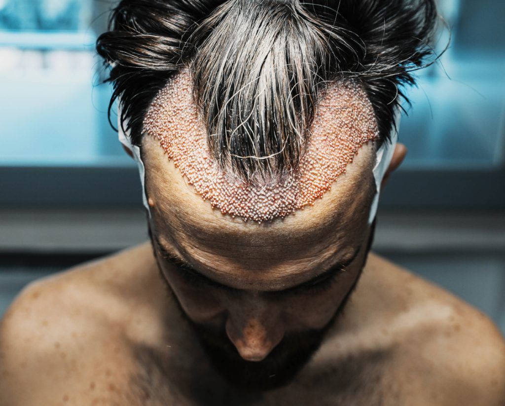 Найдорожчий варіант - трансплантація волосся, але теж без миттєвого результату. Найдорожчий варіант - трансплантація волосся, але теж без миттєвого результату.