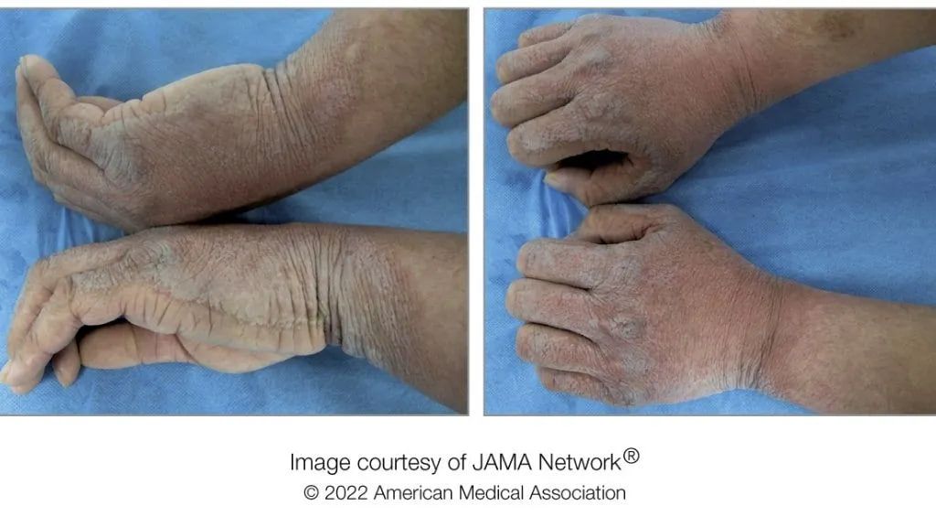 Шкіра рук чоловіка після перебування у воді ставала товстою, опухлою, зморшкуватою і лускатою Шкіра рук чоловіка після перебування у воді ставала товстою, опухлою, зморшкуватою і лускатою