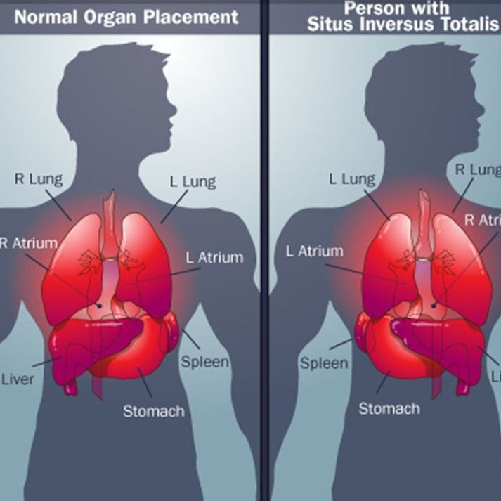 "Перевертыши" с органами могут не беспокоить человека в течение всей жизни. "Перевертыши" с органами могут не беспокоить человека в течение всей жизни.