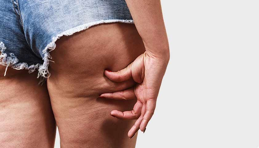 Целлюлит так мучает своих хозяек, что ради избавления от него они готовы на все. Целлюлит так мучает своих хозяек, что ради избавления от него они готовы на все.