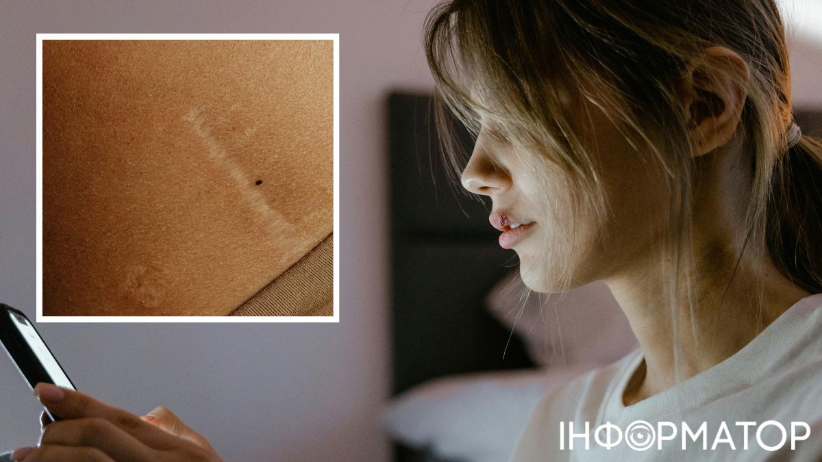 Шрамы - разглаживаются со временем, но не полностью.