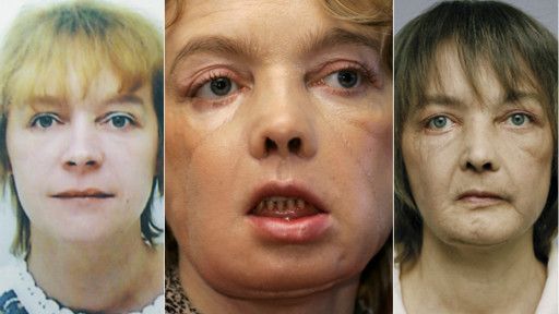 Изабель Динуар до и после пересадки лица. Изабель Динуар до и после пересадки лица.