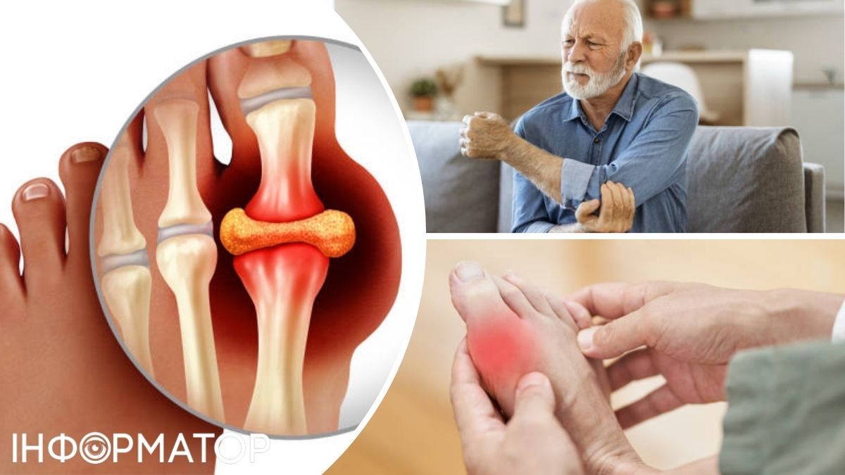 Подагры можно профилактировать и лечить, чтобы жить более качественной жизнью! Подагры можно профилактировать и лечить, чтобы жить более качественной жизнью!