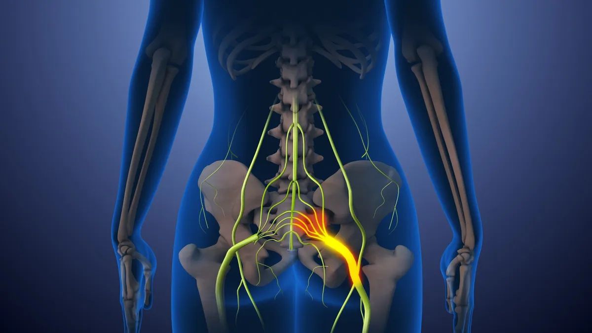 нерв, показанный ярко-желтым цветом на рисунке выше, берет свое начало в нижней части спины и идет вниз по задней части каждой ноги. нерв, показанный ярко-желтым цветом на рисунке выше, берет свое начало в нижней части спины и идет вниз по задней части каждой ноги.