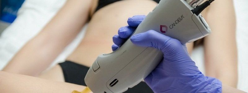 Лазерная эпиляция - CANDELA GENTLE MAX PRO со скидкой 30%