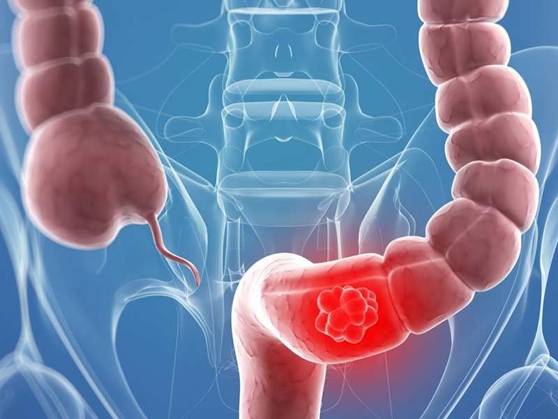 Рак толстой кишки проявляется набирает обороты