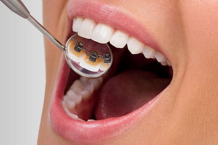 В Днепре врач-ортодонт рассказала о брекетах и как создать красивую улыбку детям и взрослым 2