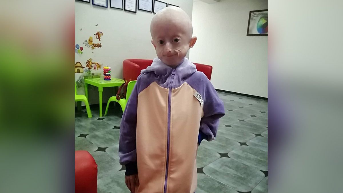 В Украине умерла 10-летняя девочка с редчайшим синдромом преждевременного старения