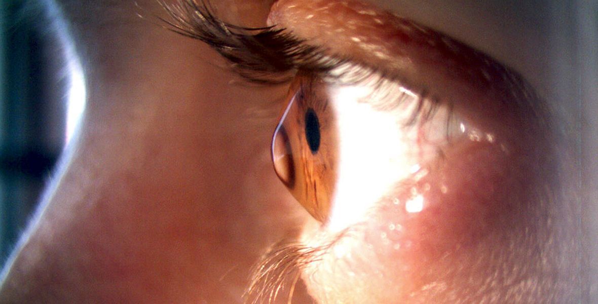 Инициатива проведения праздника направлена ​​на то, чтобы объединить людей, страдающих кератоконусом, и позволить им общаться, заниматься любимыми делами, не терять уверенности в себе