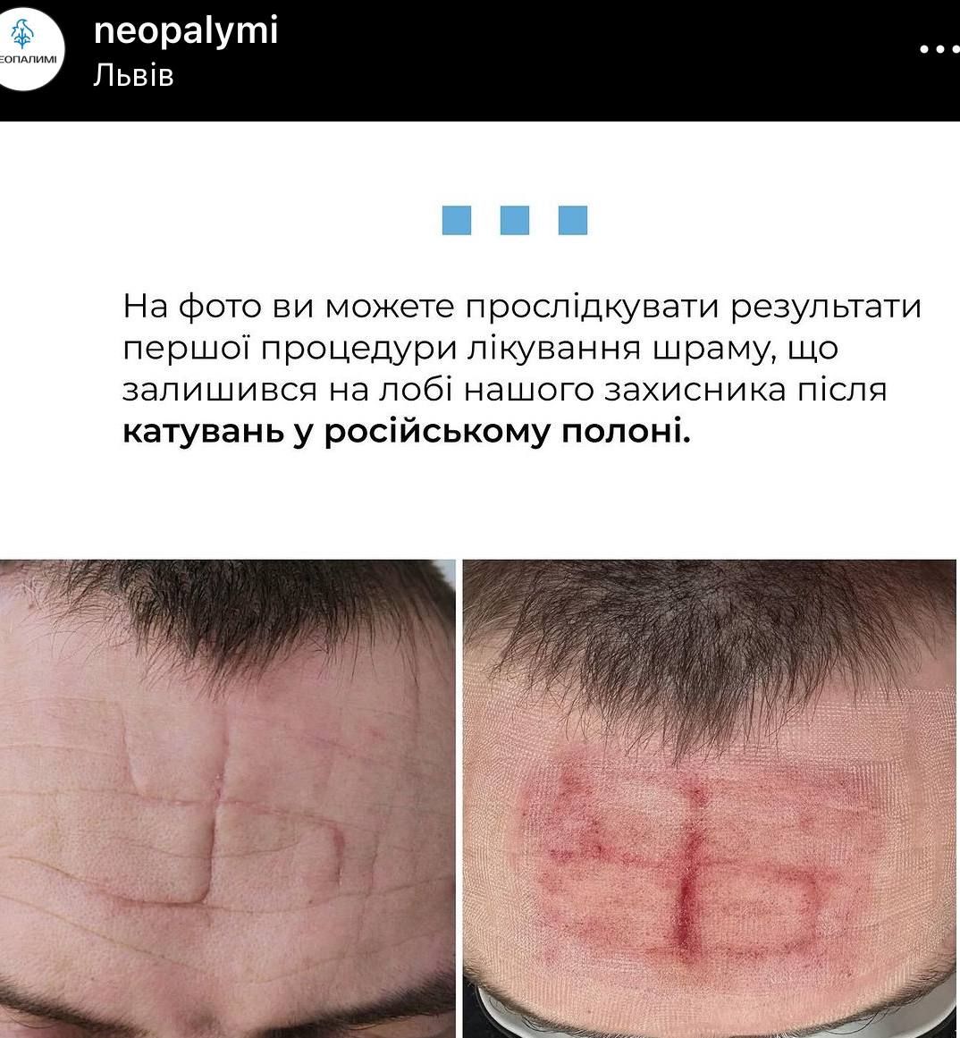 Росіяни випалюють українським полоненим сватику на чолі: доказ воєнного злочину 1 Росіяни випалюють українським полоненим сватику на чолі: доказ воєнного злочину 1