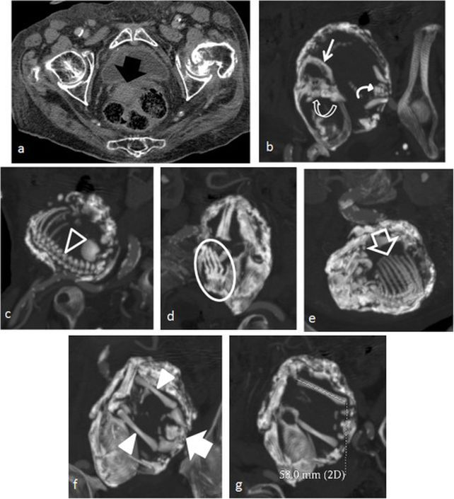 КТ літопедії черевної порожнини 77 жінки. КТ літопедії черевної порожнини 77 жінки.
