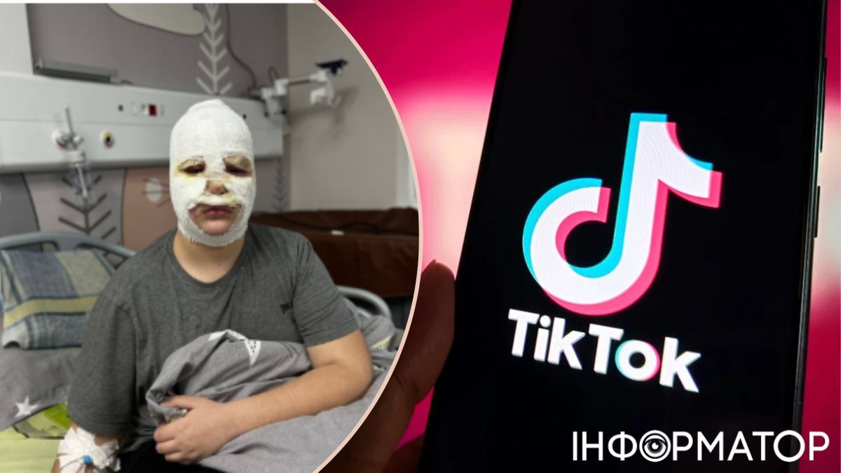 Хлопчик з опіками обличчя, TikTok