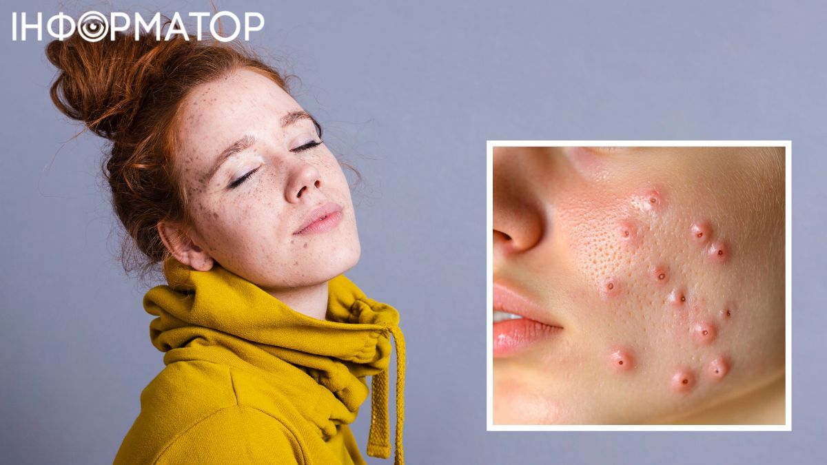 Проблемы с шкырой куда проще предупредить, чем лыковать. Проблемы с шкырой куда проще предупредить, чем лыковать.