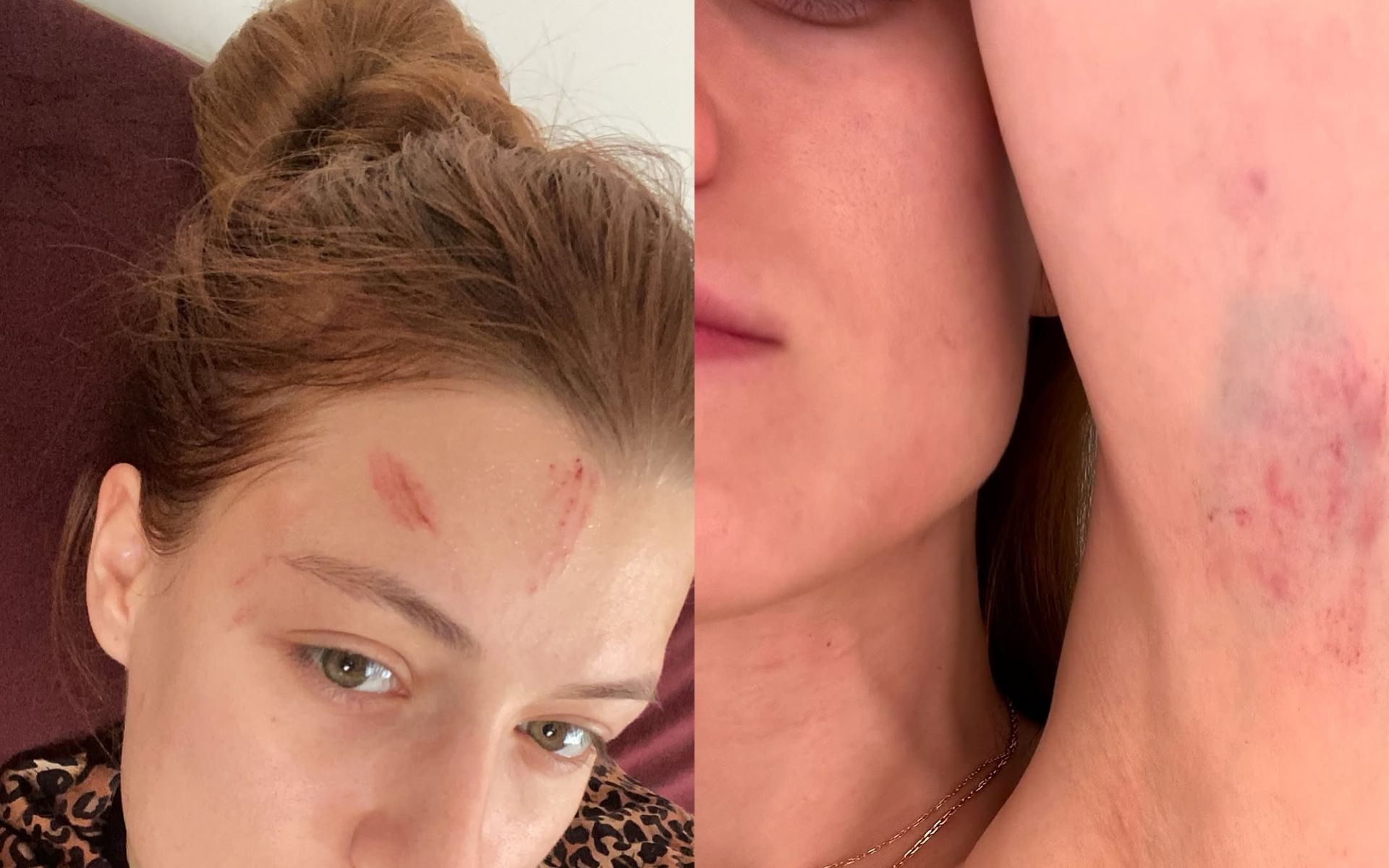 Анастасія Суббота показала себе в синцях Анастасія Суббота показала себе в синцях