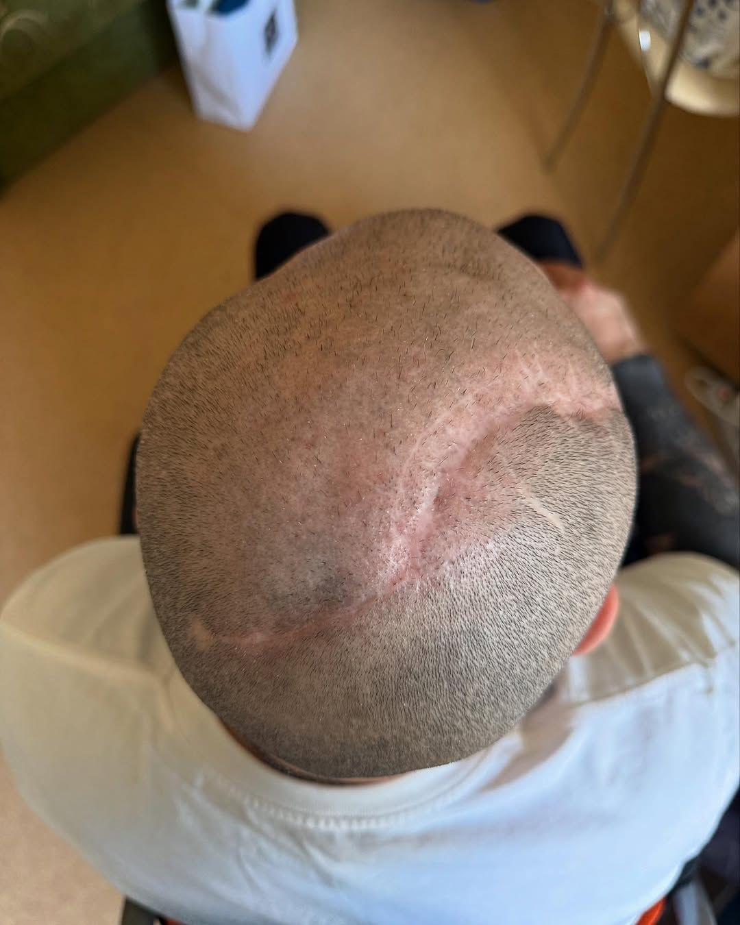 Наслідки поранення через один рік. Фото: Instagram/viktor_rozovyi