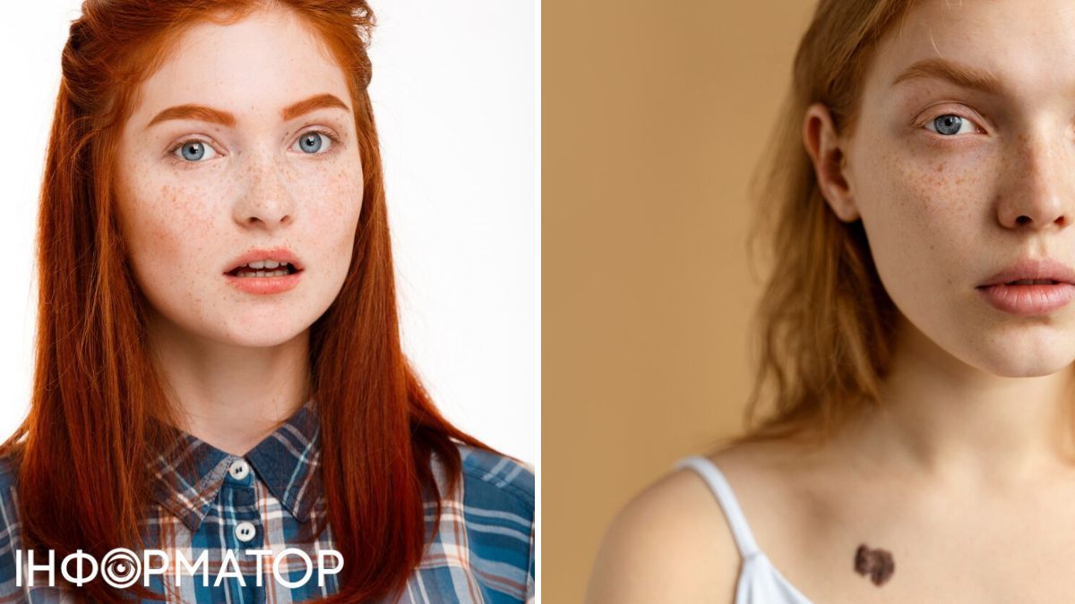 Родимки можуть збільшуватися в розмірі, а також можуть з’являтися нові.