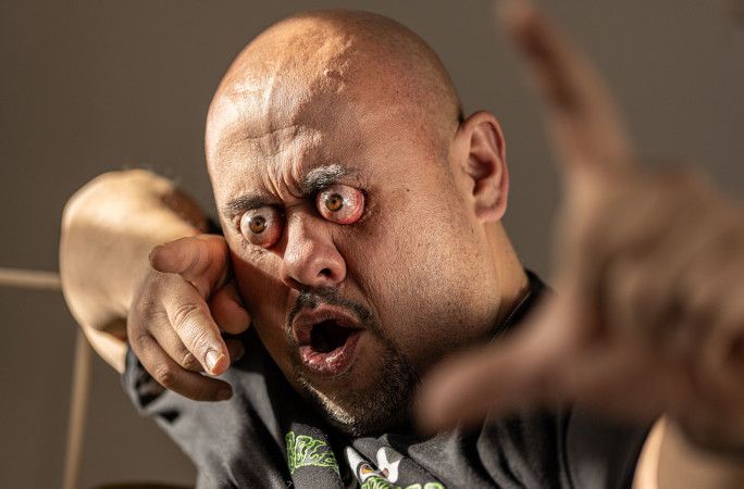 Крупний план випинання ока Вільямса Лопеса. Крупний план випинання ока Вільямса Лопеса.