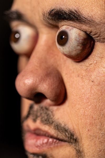 Випнуті очні яблука рекордсмена - вид збоку. Випнуті очні яблука рекордсмена - вид збоку.