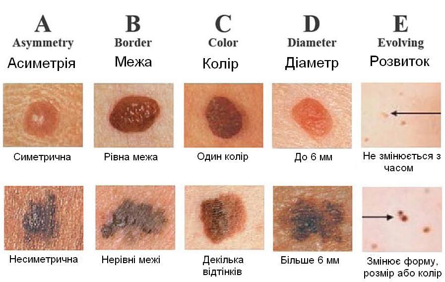 Як правильно дослідити Про що говорять родимки на тілі, так коли слід звертатись до лікаря 3