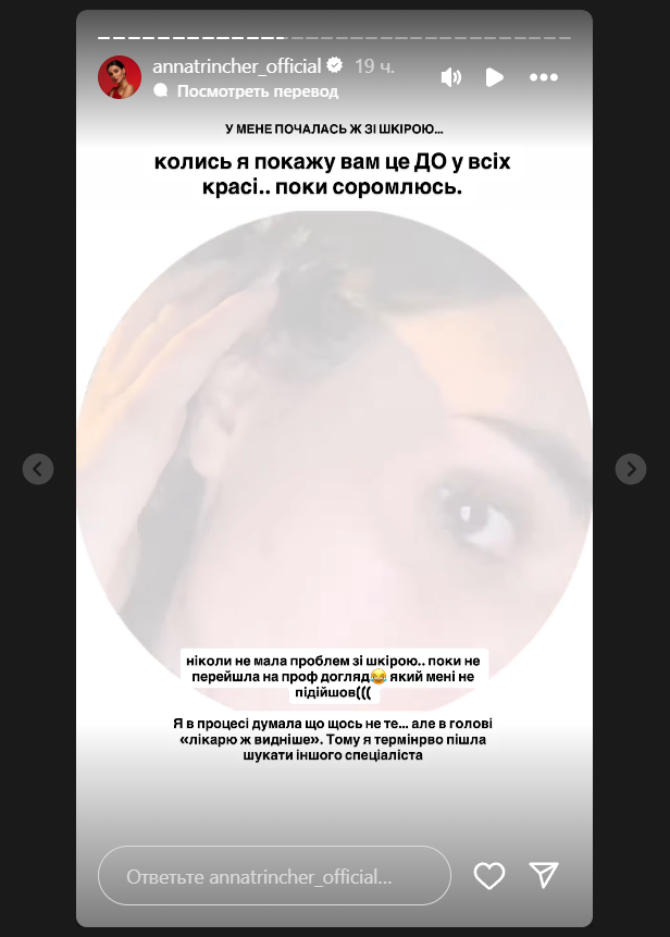 Анна Тринчер каждое утро начинает теперь с больницы - врачи и постоянные стрессы испортили лицо.