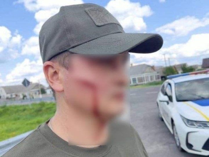 У працівника ТЦК від удару лопатою рана на щоці У працівника ТЦК від удару лопатою рана на щоці