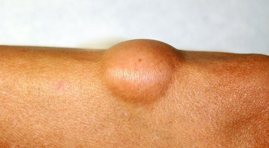 Причин виникнення шишки декілька