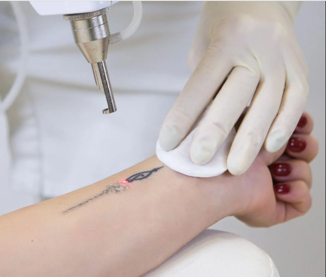 День видалення татуювань – це шанс почати все з чистого аркуша День видалення татуювань – це шанс почати все з чистого аркуша