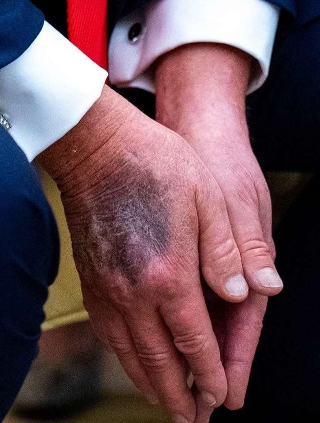 Як виглядає рука Трампа 3 вересня. Фото - Getty Images